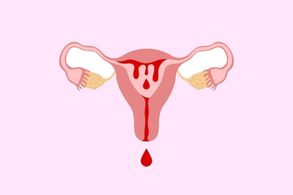 Abnormal Uterine Bleeding