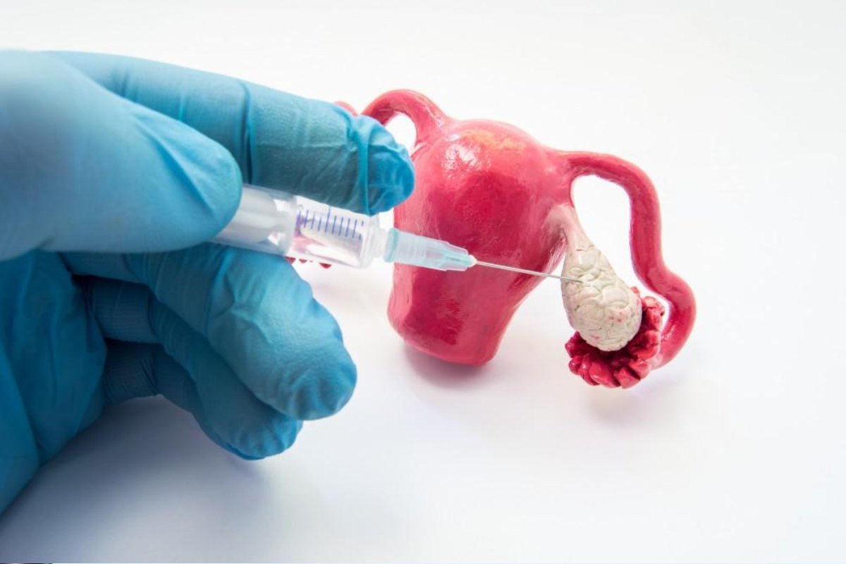 Ovulation Induction Treatment